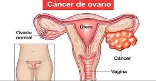 cáncer de ovarios