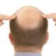 alopecia- calvicie- caida del cabello