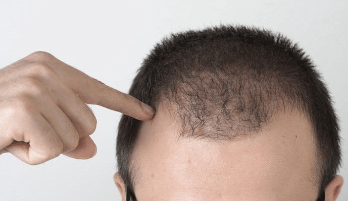 alopecia-difusa
