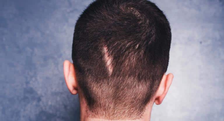 alopecia_cicatrizal