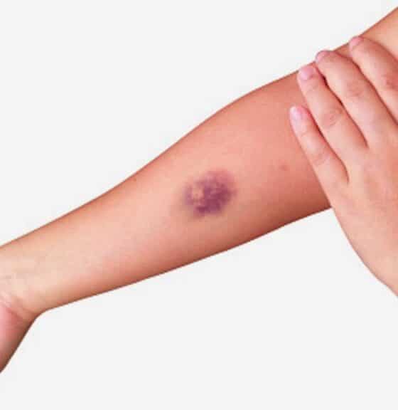 hematomas