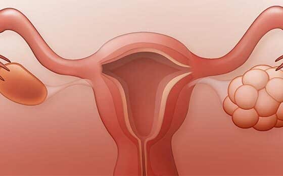 sindrome-ovario-poliquistico
