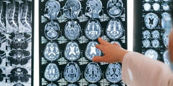 ¿Qué sabemos hasta ahora sobre la misteriosa enfermedad cerebral?