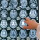 ¿Qué sabemos hasta ahora sobre la misteriosa enfermedad cerebral?