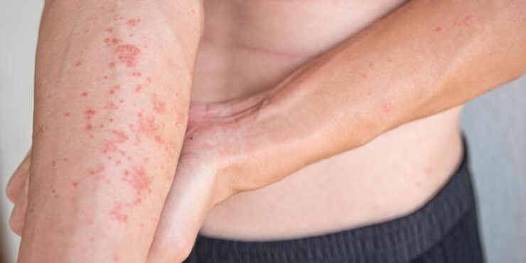 Dermatitis atópica causas