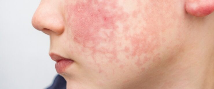 Dermatitis atópica causas