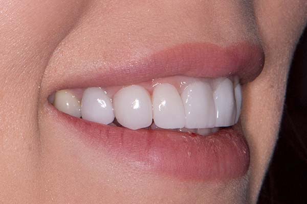 Principales ventajas de las carillas dentales