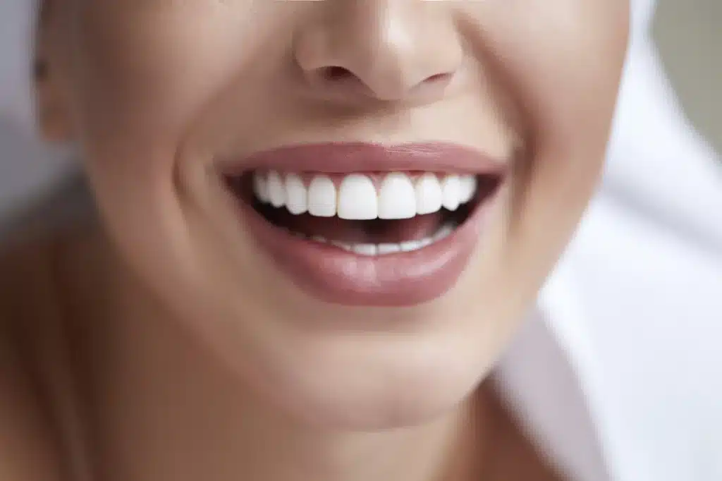 Principales ventajas de las carillas dentales